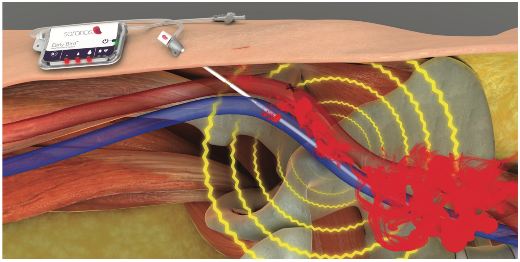 Early Bleed Detection With the Early Bird® Bleed Monitoring System CLD